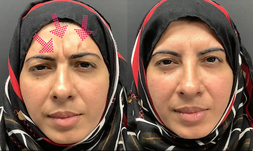 Frown Line Reduction Before After Mississauga oakville